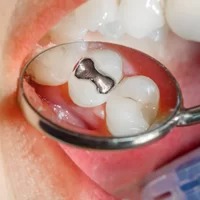 Amalgam Fillings