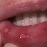 Aphthous ulcers