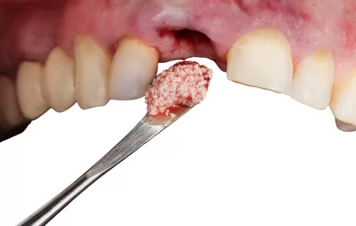 Bone Grafts