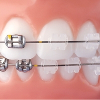 Ceramic Braces