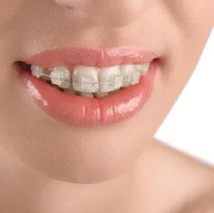 Ceramic invisible braces