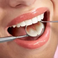 Composite Fillings