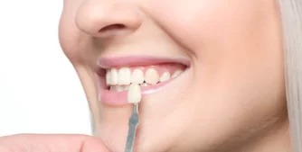 Composite Veneers