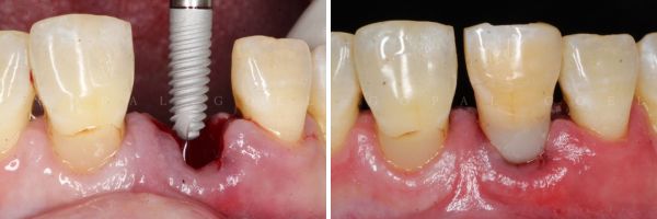 DENTAL IMPLANT BEFORE AFTER