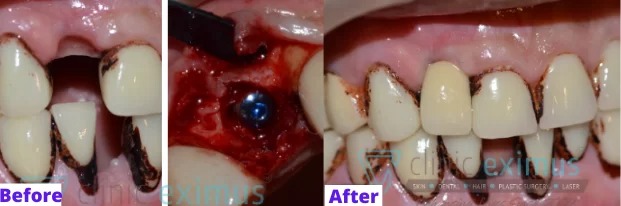 DENTAL IMPLANT BEFORE AFTER