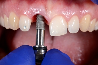 Dental Implants