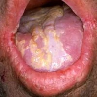 Fungal infections