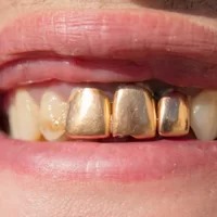 Gold Fillings