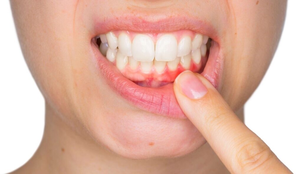 Gum diseases side