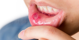 Mouth ulcers