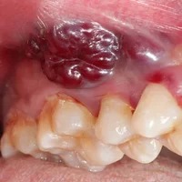 Oral Cancer