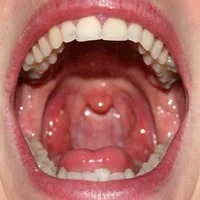 Oral Manifestation of Skin Diseases