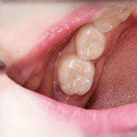 Pit and fissure sealants