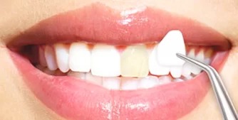 Porcelain Veneers