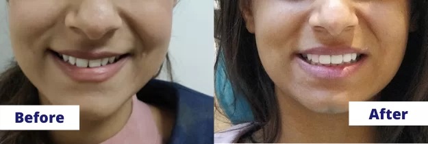 Smile Makeover before and after