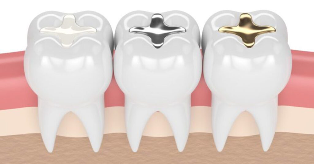 Tooth Gap Filling