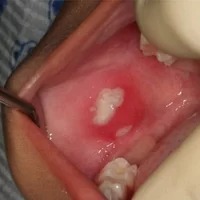 Traumatic Ulcers