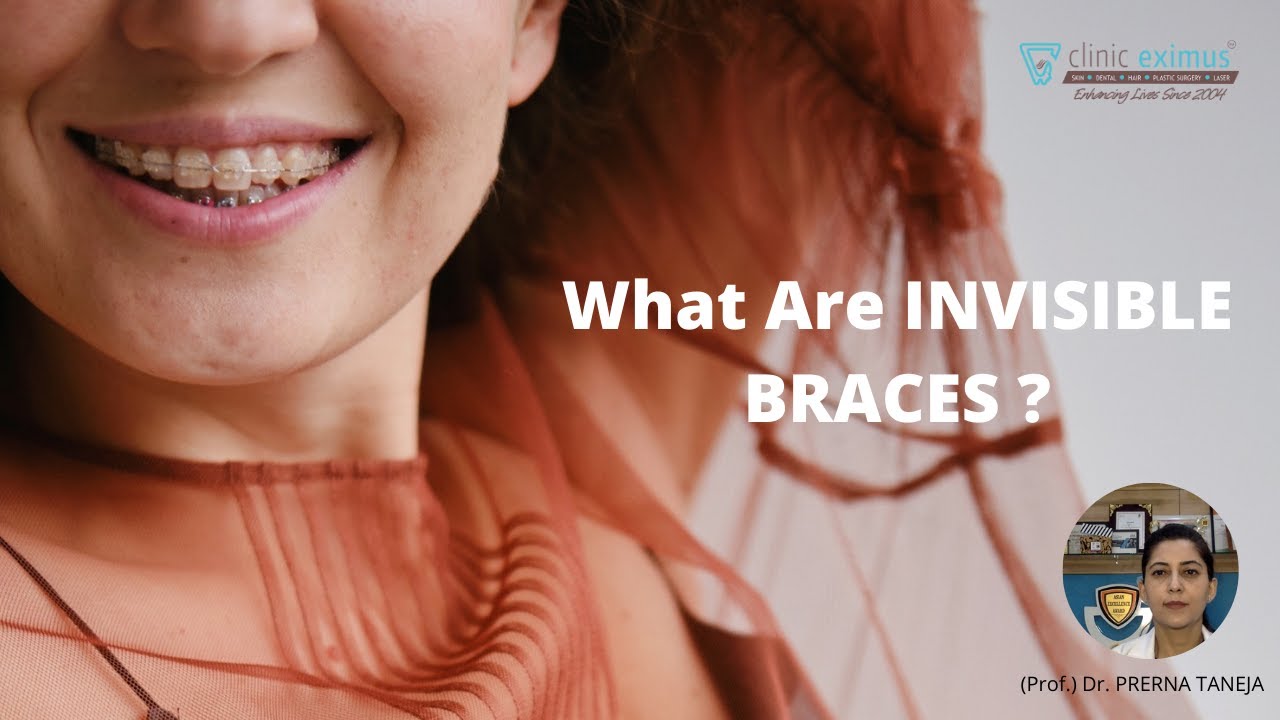 What are Invisible Braces