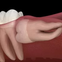 Wisdom dental Tooth